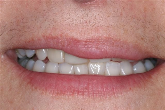lowell dentist porcelain crown before photo